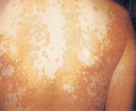 背部白癜风常见的发病原因有哪些