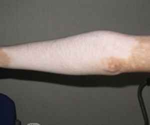 儿童肢端型白癜风病因有哪些